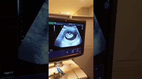6 haftalık erkek bebek ultrason görüntüleri